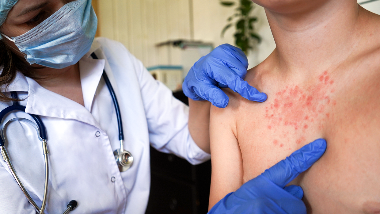 Симптомы вирусного гепатита.