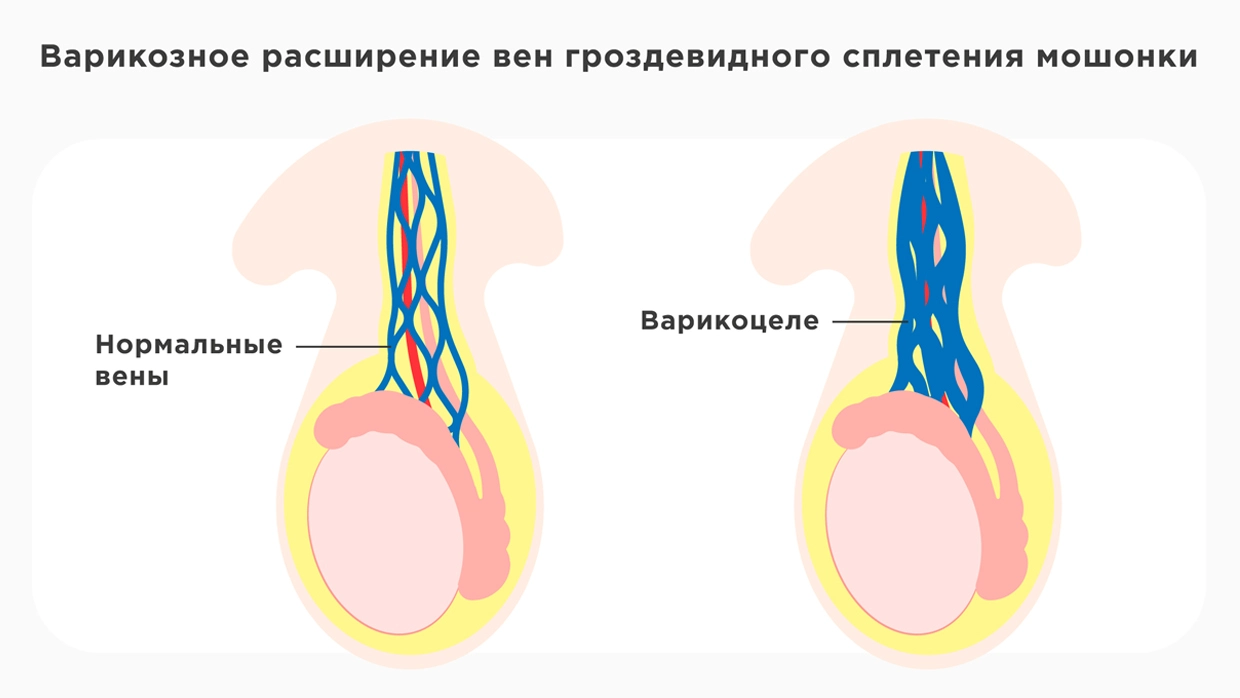 Правое яичко