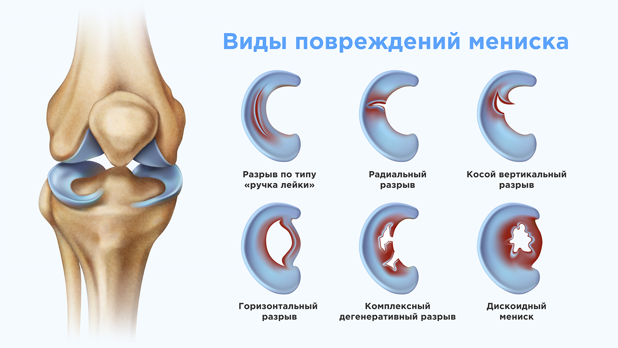 Виды повреждений мениска.